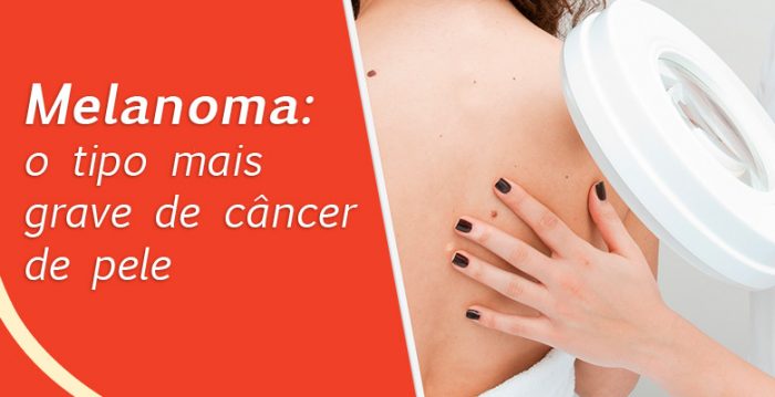 Inderma Melanoma O Tipo Mais Grave De Câncer De Pele